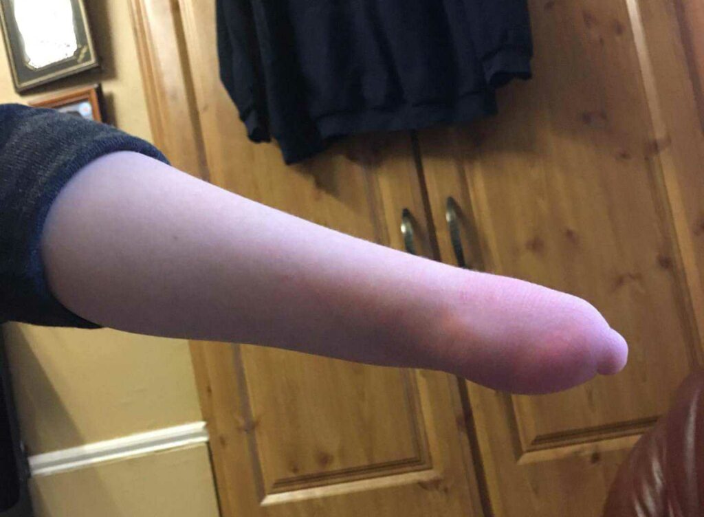 wrist with no hand limb difference